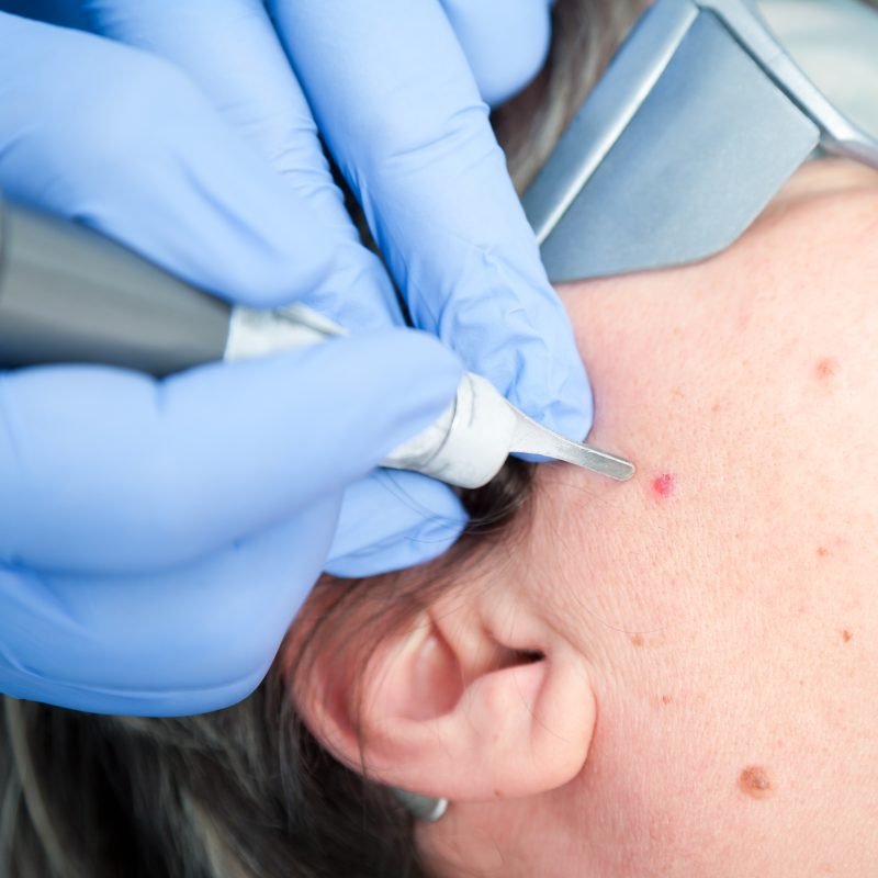 Leberfleck Laser Kosmetik