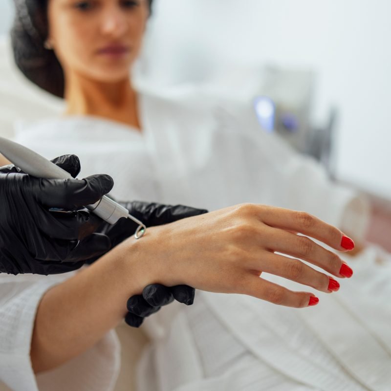Beautiful caucasian young woman is doing a mole removal procedure in a modern beauty cosmetic dermatological clinic