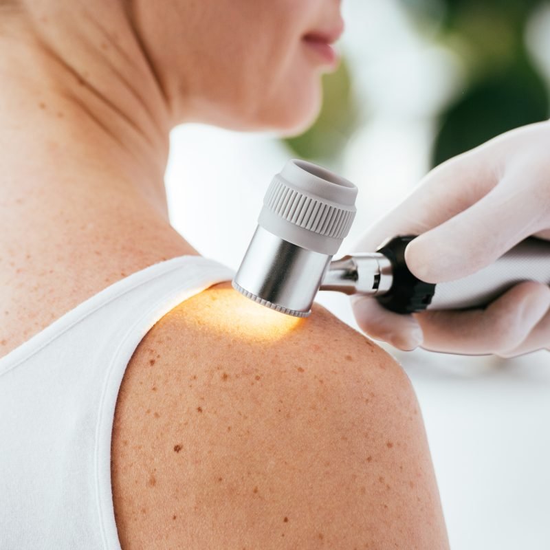 cropped view of dermatologist holding dermatoscope while examini